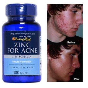 Zinc For acne Pattanás elleni komplex tabletta 100 db