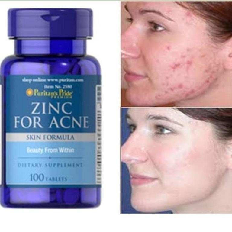 Zinc For acne tabletta a pattanásmentes bőrért